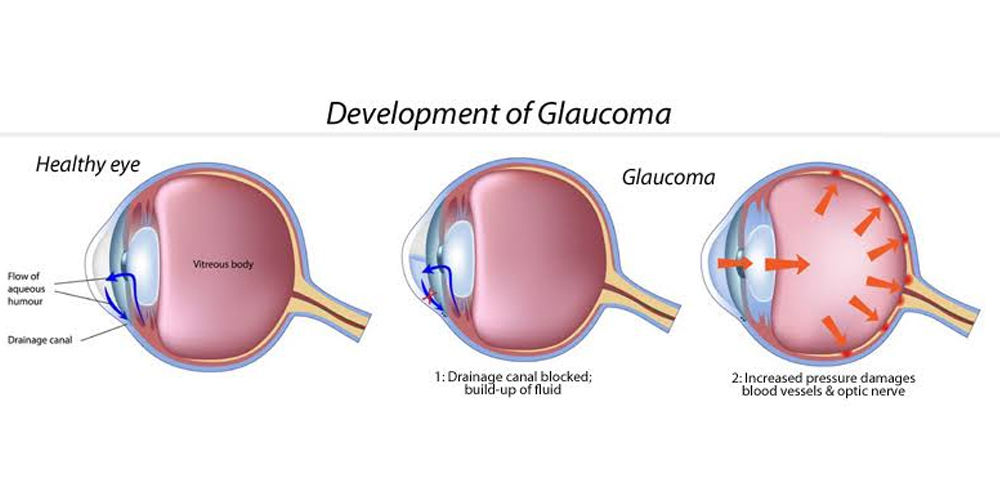 glaucoma treatment at ulwe eye clinic navi mumbai