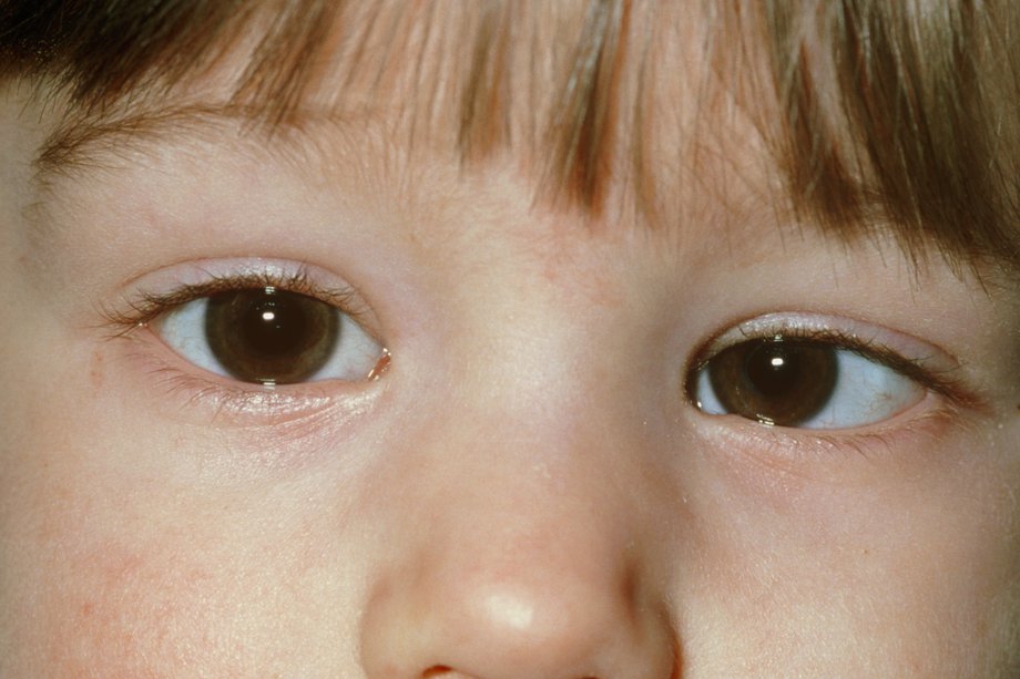 strabismus & squint correction at ulwe eye clinic navi mumbai